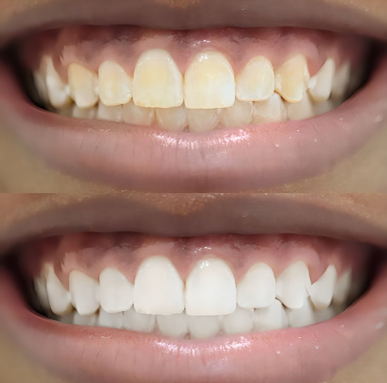 Teeth Whitening Kit