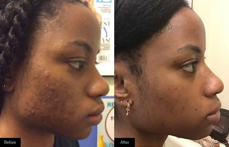 Salicylic Acid Acne Set