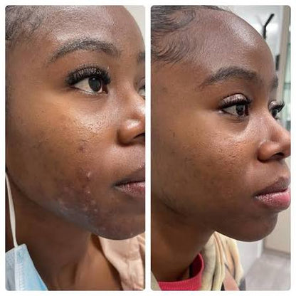 Salicylic Acid Acne Set